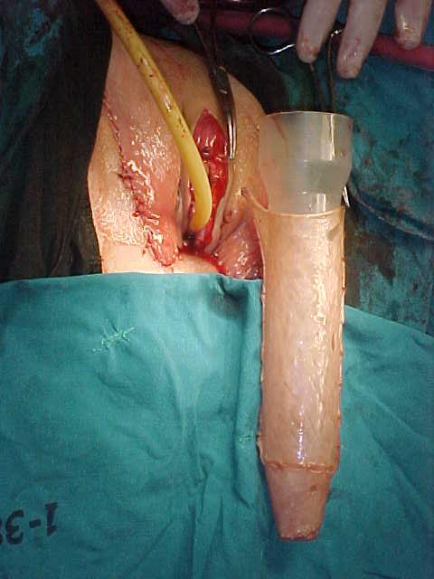 Opinion you man to woman sex reassignment surgery pictures share your Can man to woman sex reassignment surgery pictures